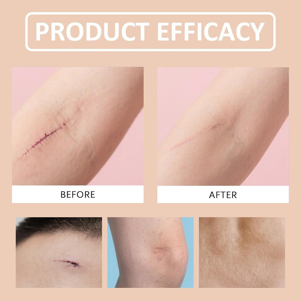 Silicone Scar Stick, Silicone Stick for Face and Body, Help to Improve the Appearance of Scars, For Use After Surgery, Acne, Burns, Cuts, Lightweight Easy to Use (1Pc)